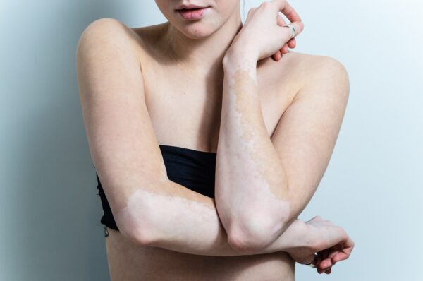 Baltmė (lot. vitiligo) | Inovatyvios Dermatologijos Centras